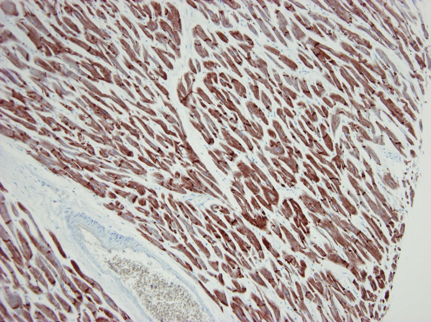Figure 1. Formalin fixed, paraffin embedded human heart tissue immunostained for alpha cardiac actin using MUB0109P (clone 22D3) at a 500x dilution. Note the strong staining of cardiac muscle tissue.